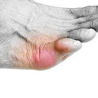 Up-to-date management of gout