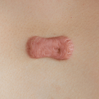 Keloid scars