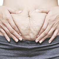 Abdominal separation during pregnancy