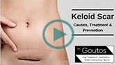 Keloid Scars - Causes, Treatment & Prevention