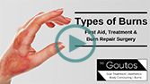 Types of Burns - First Aid, Treatment & Burn Repair Surgery