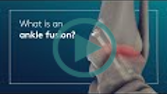 What is an ankle fusion?