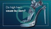 Do high heels cause bunions?